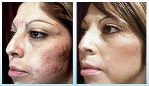 laser acne treatment Denver