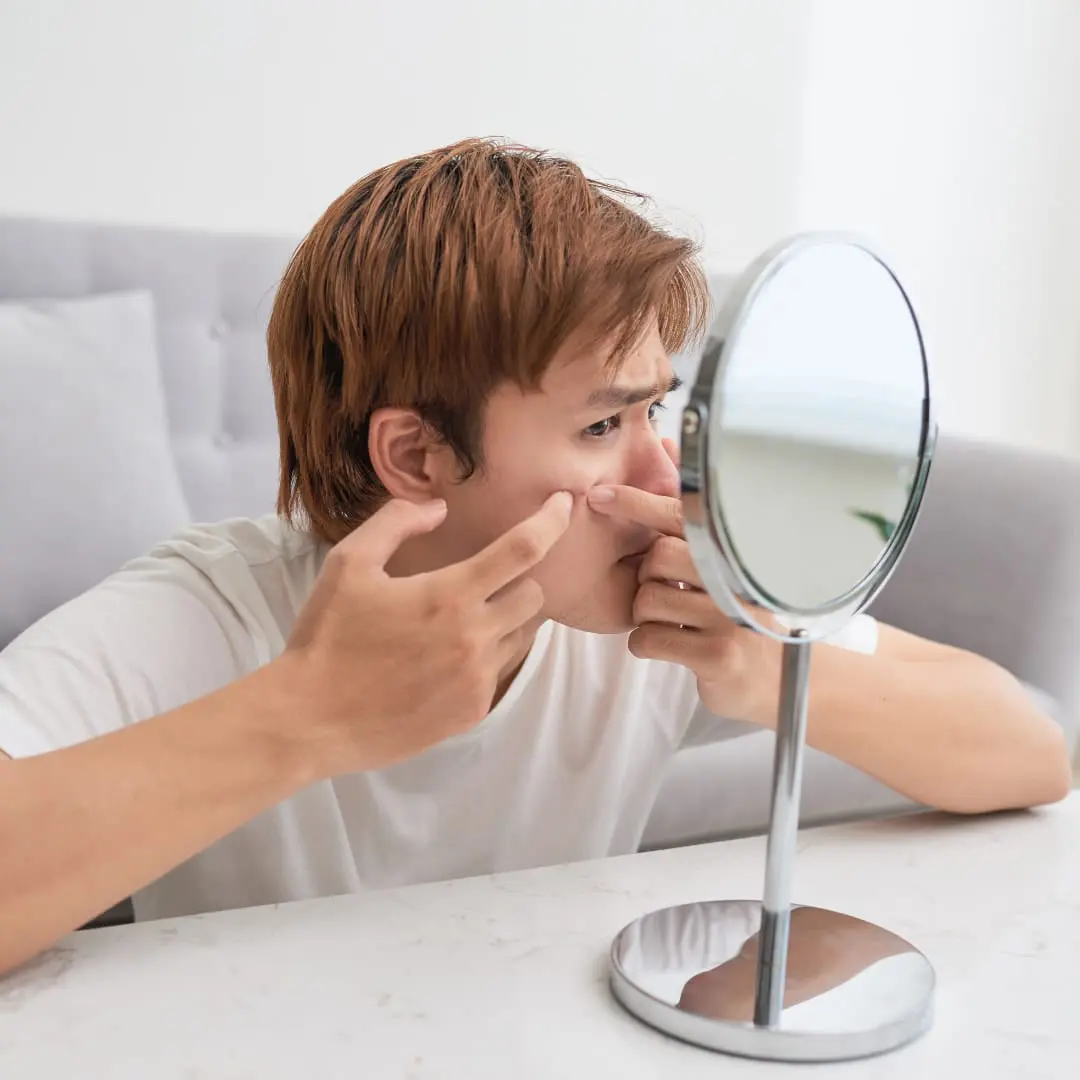 Best Acne Treatments for Men