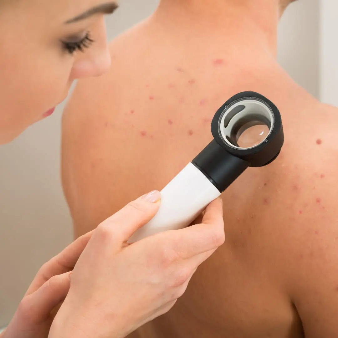Body Acne Treatments