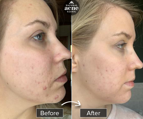 Before & After