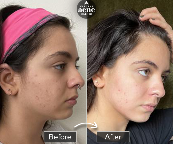 Before & After
