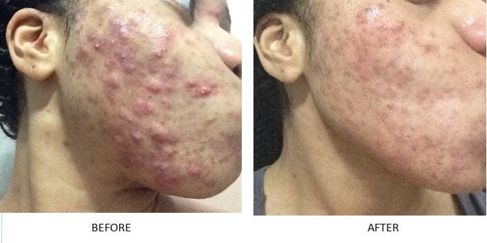 Natural Acne Clinic Reviews Natural Acne Clinic Reviews