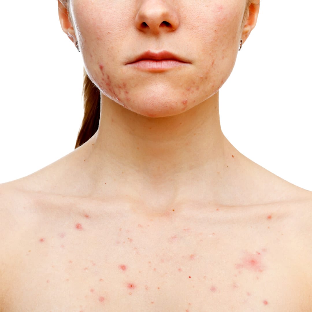 Hormonal Acne Caused by Androgen Testosterone Imbalance
