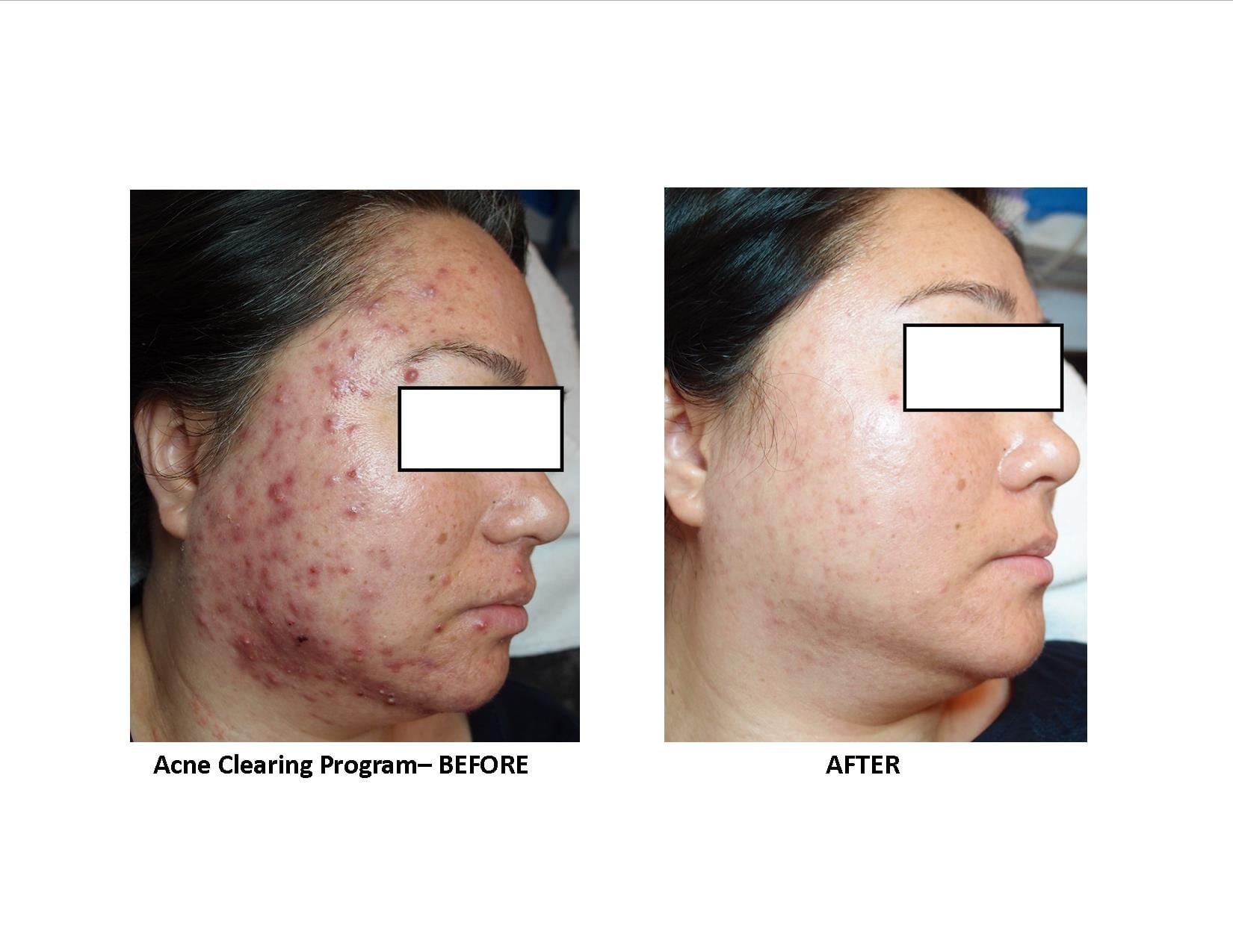 Natural Acne Clinic Reviews Natural Acne Clinic Reviews