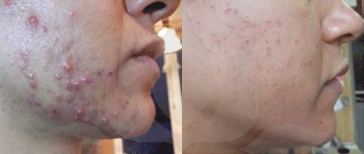 Natural Acne Clinic | Online & In-Clinic Natural Acne Treatments & Programs