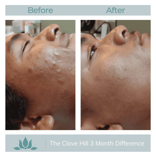 Saw Palmetto for Hormonal Acne | Natural Acne Clinic