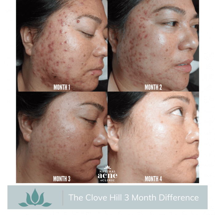 Clove Hill Acne Gel 2.8 Natural Acne Clinic
