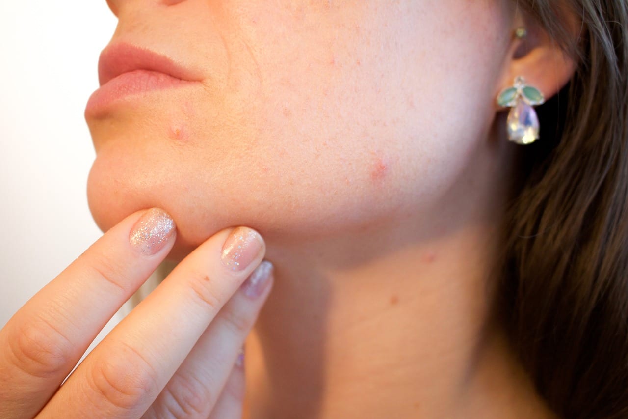 Acne on woman's jawline