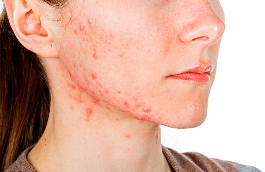 Young girl with skin problem