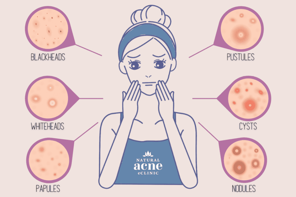 Types of Acne