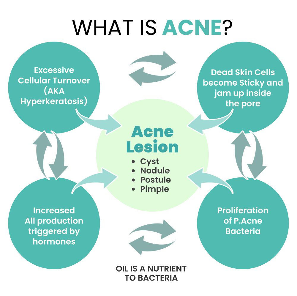 Acne Lesion