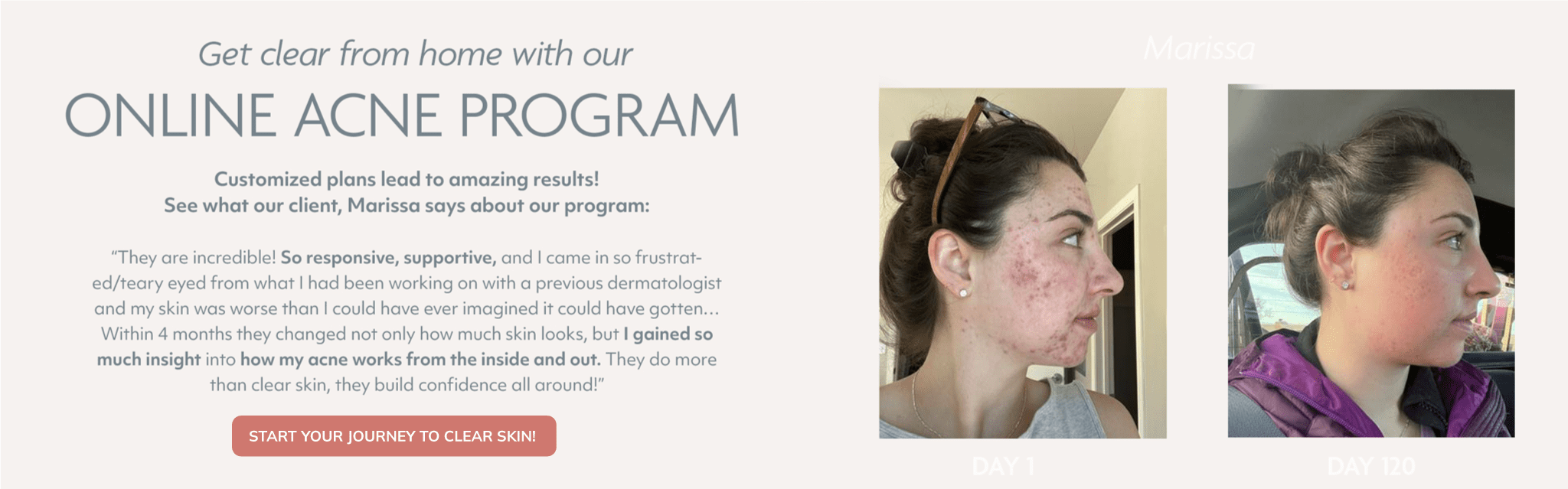 Online Acne Program