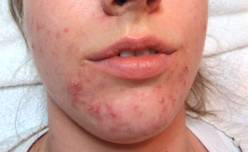 Opinion: Healing my inflamed, acne-ridden skin after coming off the  contraceptive pill