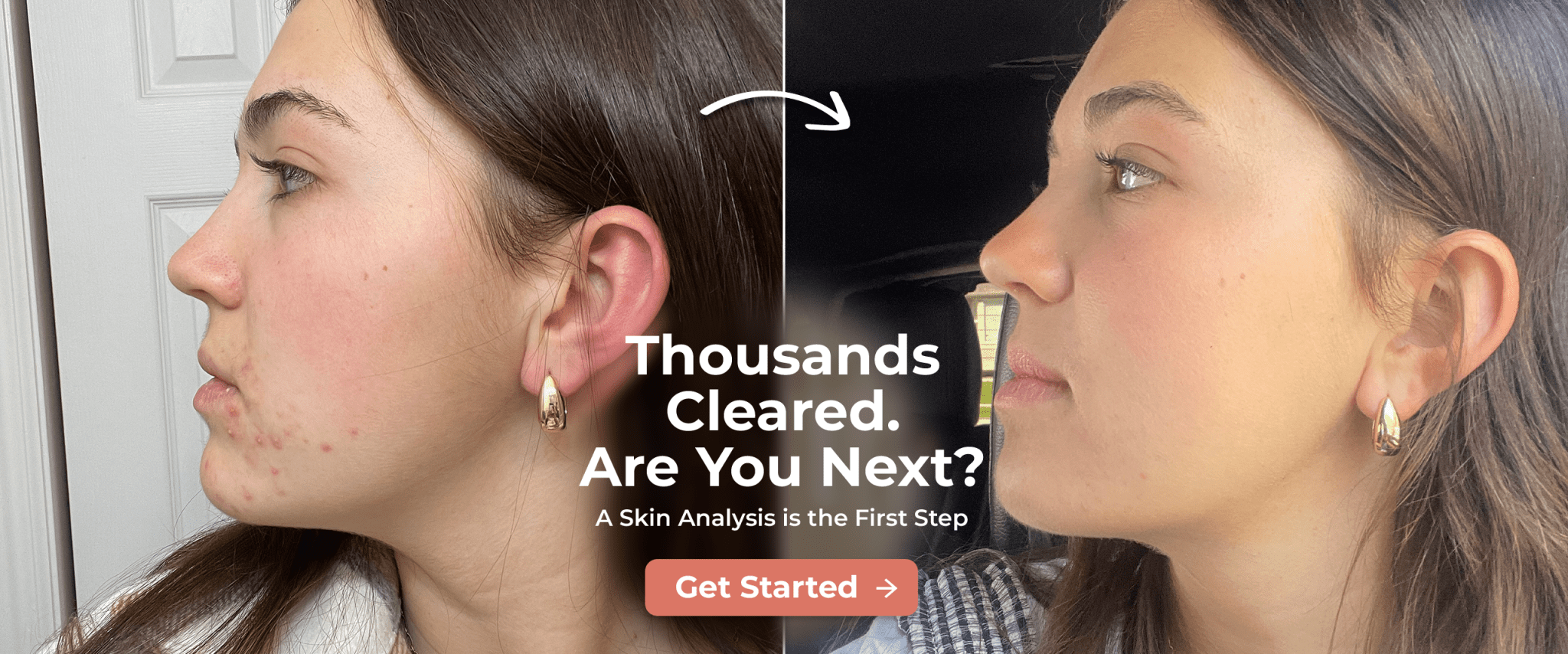 Natural Acne Clinic | Award Winning In-Person & Online Acne Programs