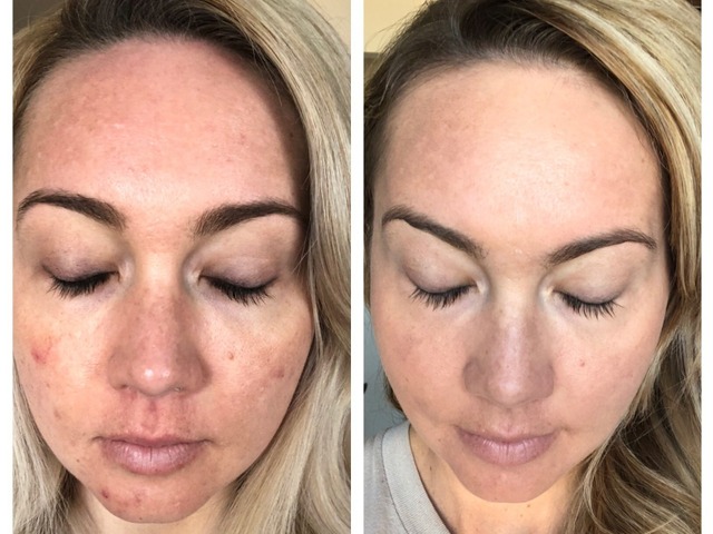 Online Acne Program Testimonial Image By Lindsay Bernardo